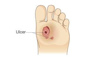 Foot Ulcers and Proper Wound Care