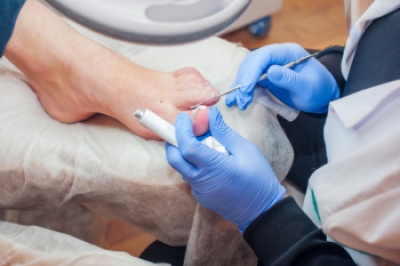 Recognizing the Stages of Toenail Fungus