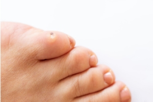 Types of Corns on the Feet
