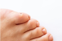 Types of Corns on the Feet